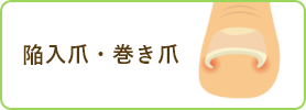 陥入爪・まき爪