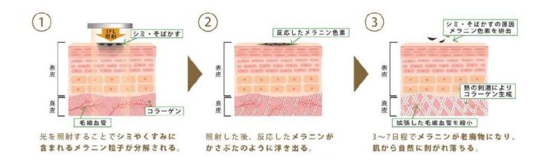 IPL 治療(光治療、フォト治療)2024 年 2 月開始のアイキャッチ画像